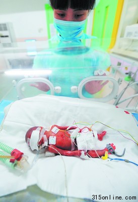 袖珍嬰兒出生體重僅500克捧起他像捧塊豆腐（圖）