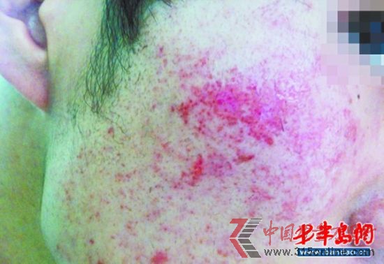 小馮面部嚴(yán)重過敏,布滿了紅疙瘩。 小馮面部嚴(yán)重過敏,布滿了紅疙瘩。